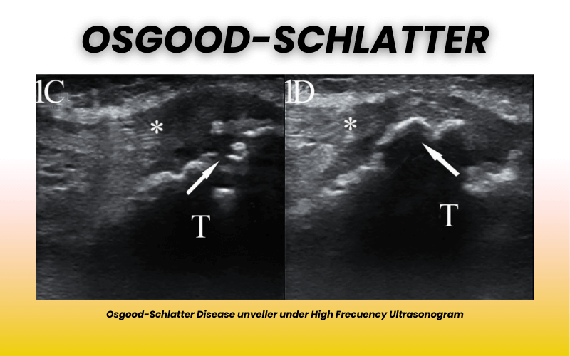 3. Osgood-Schlatter patologia rodilla.png